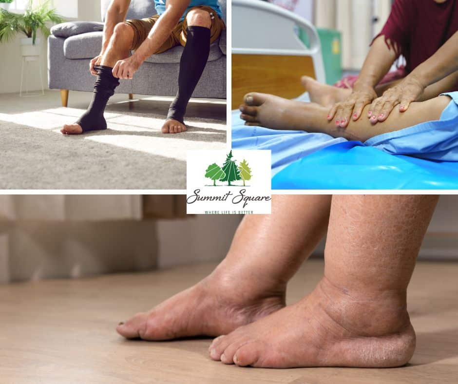 "Collage highlighting lymphedema care at Summit Square, featuring images of a person putting on compression socks, a caregiver performing a leg massage, and swollen feet with dry skin. The Summit Square logo is centered with the tagline 'Where Life Is Better'."